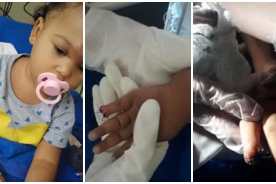 Menina teve dedo decepado por enfermeira, que foi tirar atadura com tesoura (Foto/TV Globo/Reprodução)