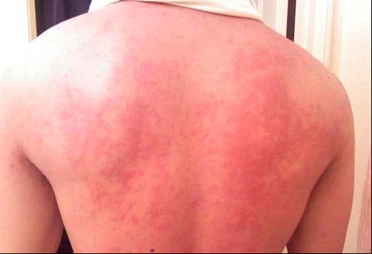 Foram registrados 87.938 casos prováveis de chikungunya, dos quais 68.148 tiveram confirmação (Foto/Reprodução)