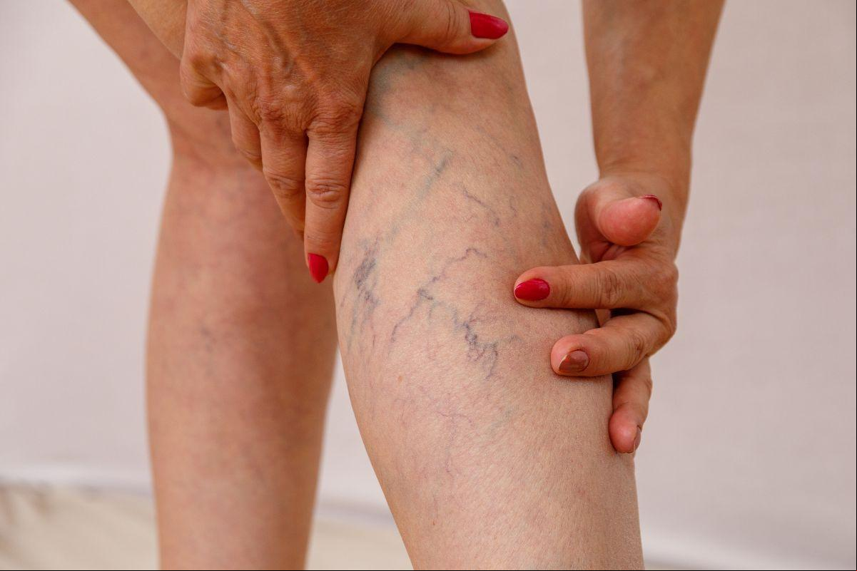 O calor provoca a dilatação das veias, dificultando o retorno do sangue ao coração. Isso pode causar inchaço, sensação de peso nas pernas e até dores (Foto/Reprodução)