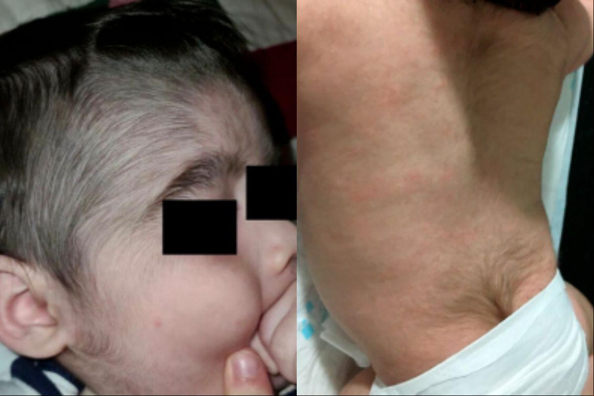 Bebês com hipertricose após contato com minoxidil (Foto/Dermatologic Therapy/Pediatric Dermatology/Reprodução)