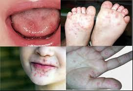A síndrome mão-pé-boca, infecção viral comum na infância, tem apresentado maior incidência em crianças pequenas, especialmente aquelas em idade escolar (Foto: Reprodução)