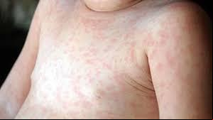 É importante estar atento às diferenças para garantir um diagnóstico adequado. (Foto: Reprodução)